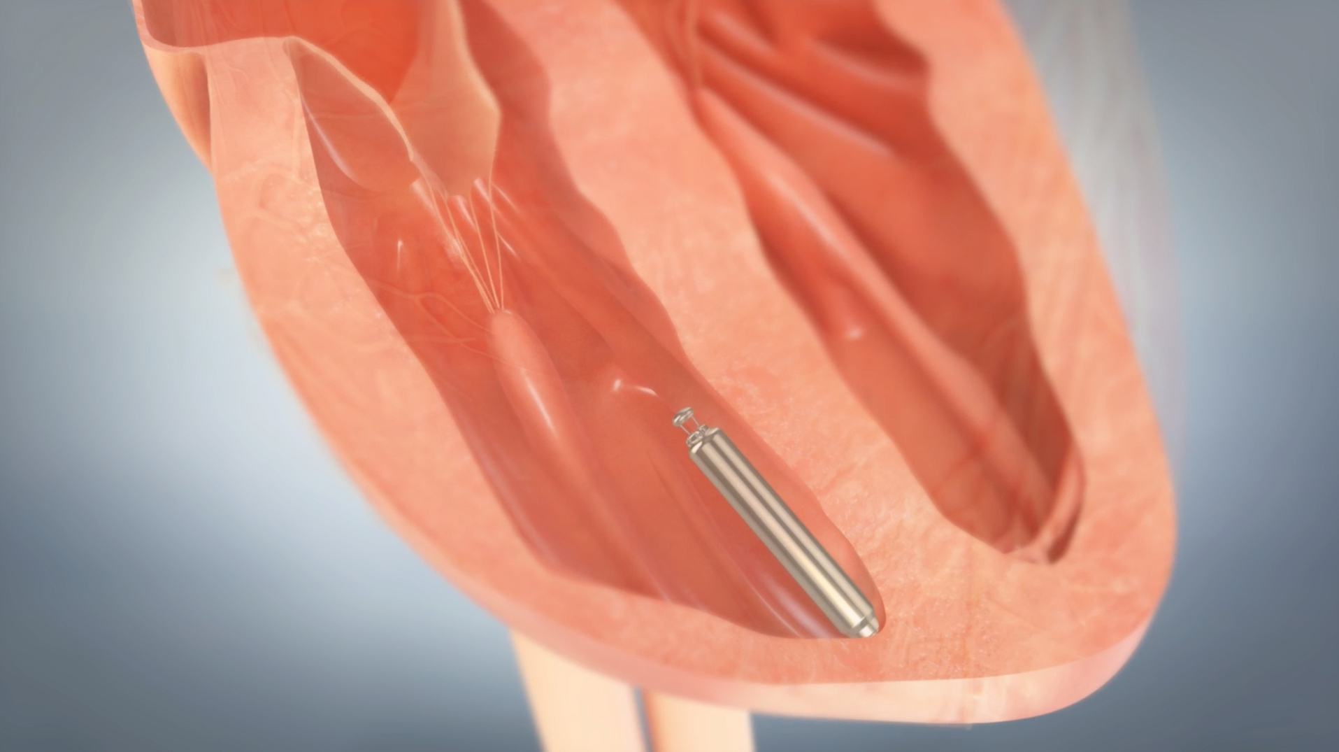 First Leadless Pacemaker in United States Implanted into a Patient at